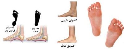 صافی کف پا، منشا بیماری های اسکلتی